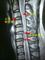 Disc Herniation Disc Herniation